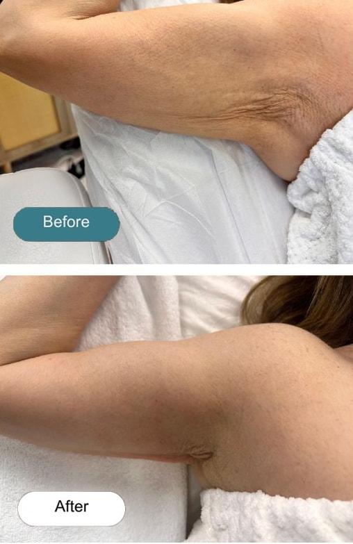 Laser Skin Resurfacing result at Dvida Spa | Med Spa Services 60654 in Chicago, IL