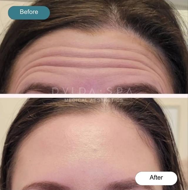 Botox result at Dvida Spa | Med Spa Services 60654 in Chicago, IL