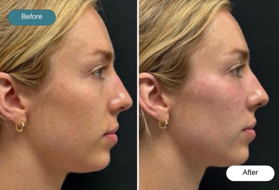 Dvida Spa | Med Spa Services 60654 under-eye filler result — Chicago, IL