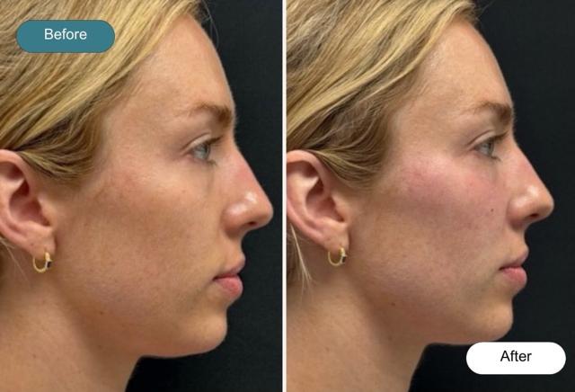 Juvederm result at Dvida Spa | Med Spa Services 60654 in Chicago, IL