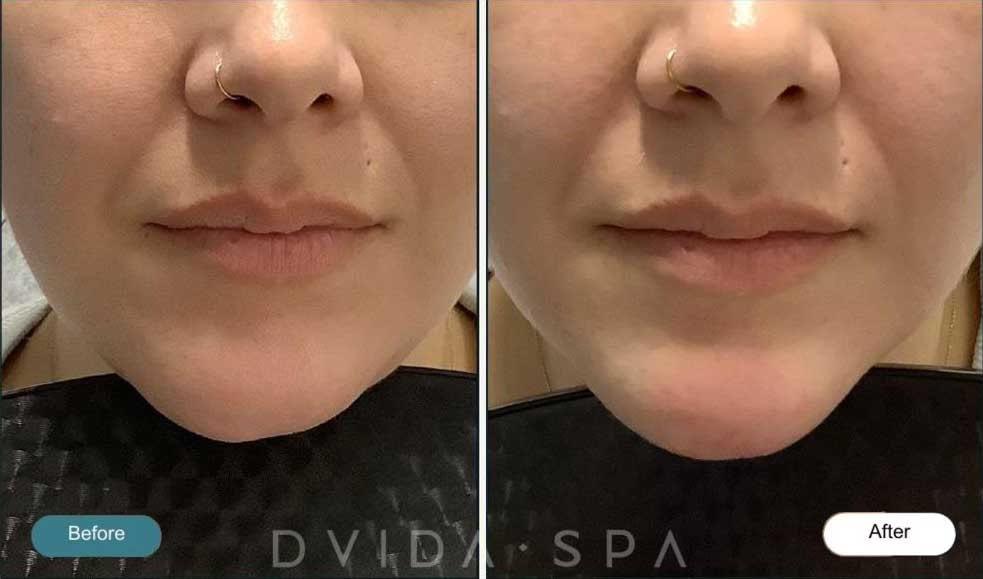 Dvida Spa | Med Spa Services 60654 jawline filler result — Chicago, IL