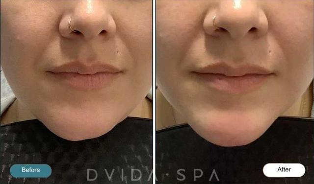 Juvederm result at Dvida Spa | Med Spa Services 60654 in Chicago, IL