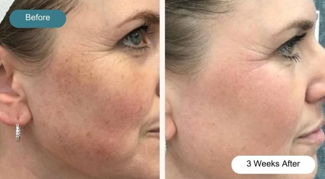 Laser Skin Resurfacing result at Dvida Spa | Med Spa Services 60654 in Chicago, IL
