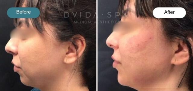 Breast Augmentation result at Dvida Spa | Med Spa Services 60654 in Chicago, IL