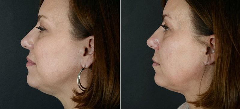 Anderson Sobel Cosmetic Surgery double chin treatment result โ Bellevue, WA