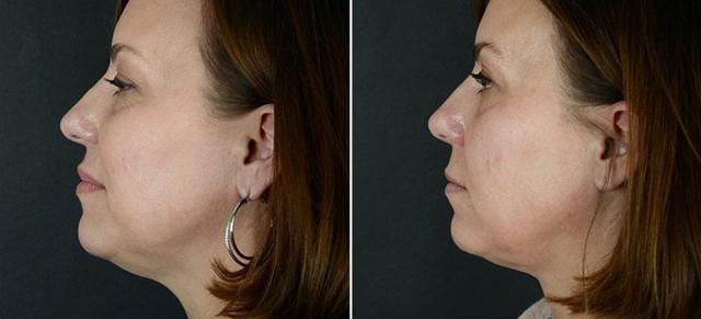 Kybella result at Anderson Sobel Cosmetic Surgery in Bellevue, WA