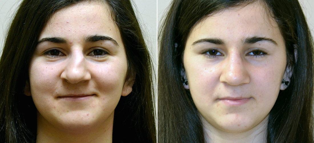 Anderson Sobel Cosmetic Surgery rhinoplasty result โ Bellevue, WA