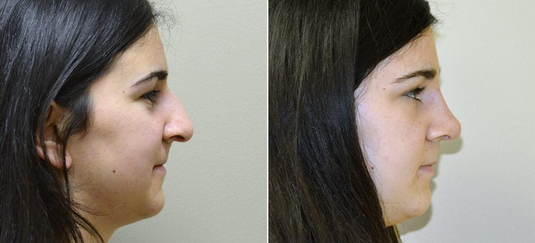 Anderson Sobel Cosmetic Surgery rhinoplasty result โ Bellevue, WA