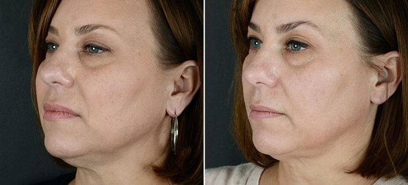 Anderson Sobel Cosmetic Surgery double chin treatment result — Bellevue, WA
