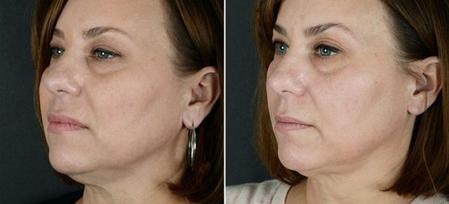 Kybella result at Anderson Sobel Cosmetic Surgery in Bellevue, WA