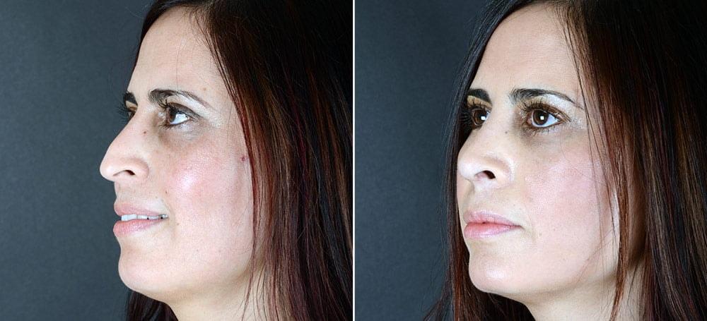 Anderson Sobel Cosmetic Surgery rhinoplasty result — Bellevue, WA