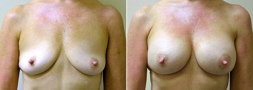 Anderson Sobel Cosmetic Surgery breast augmentation result โ Bellevue, WA