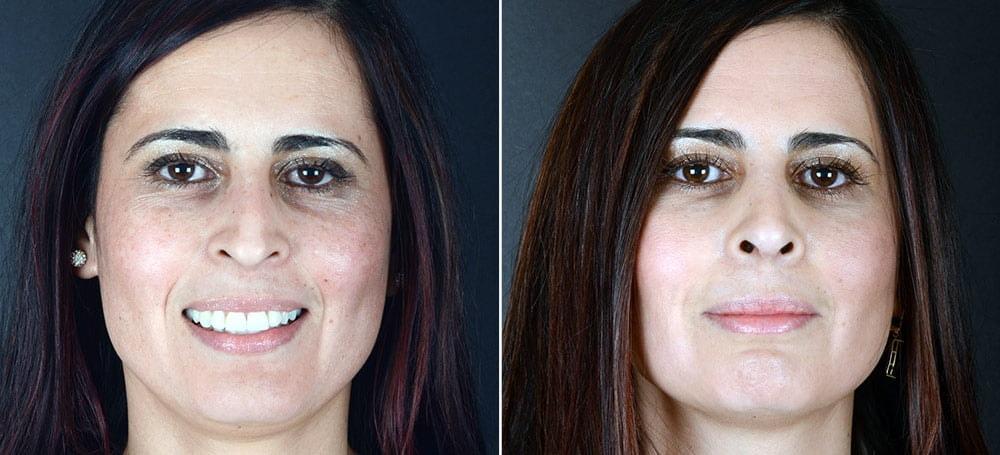 Anderson Sobel Cosmetic Surgery rhinoplasty result — Bellevue, WA
