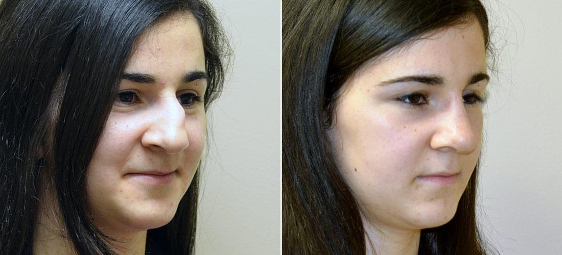 Anderson Sobel Cosmetic Surgery rhinoplasty result โ Bellevue, WA