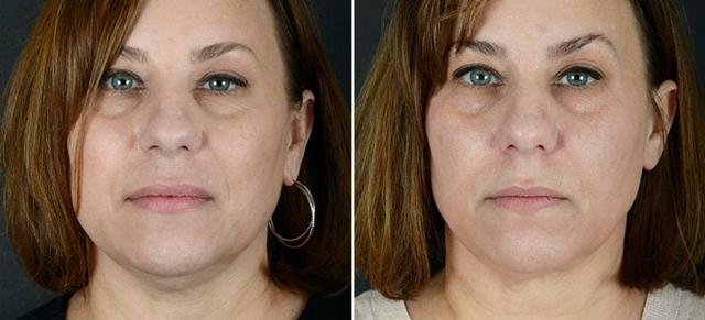 Kybella result at Anderson Sobel Cosmetic Surgery in Bellevue, WA