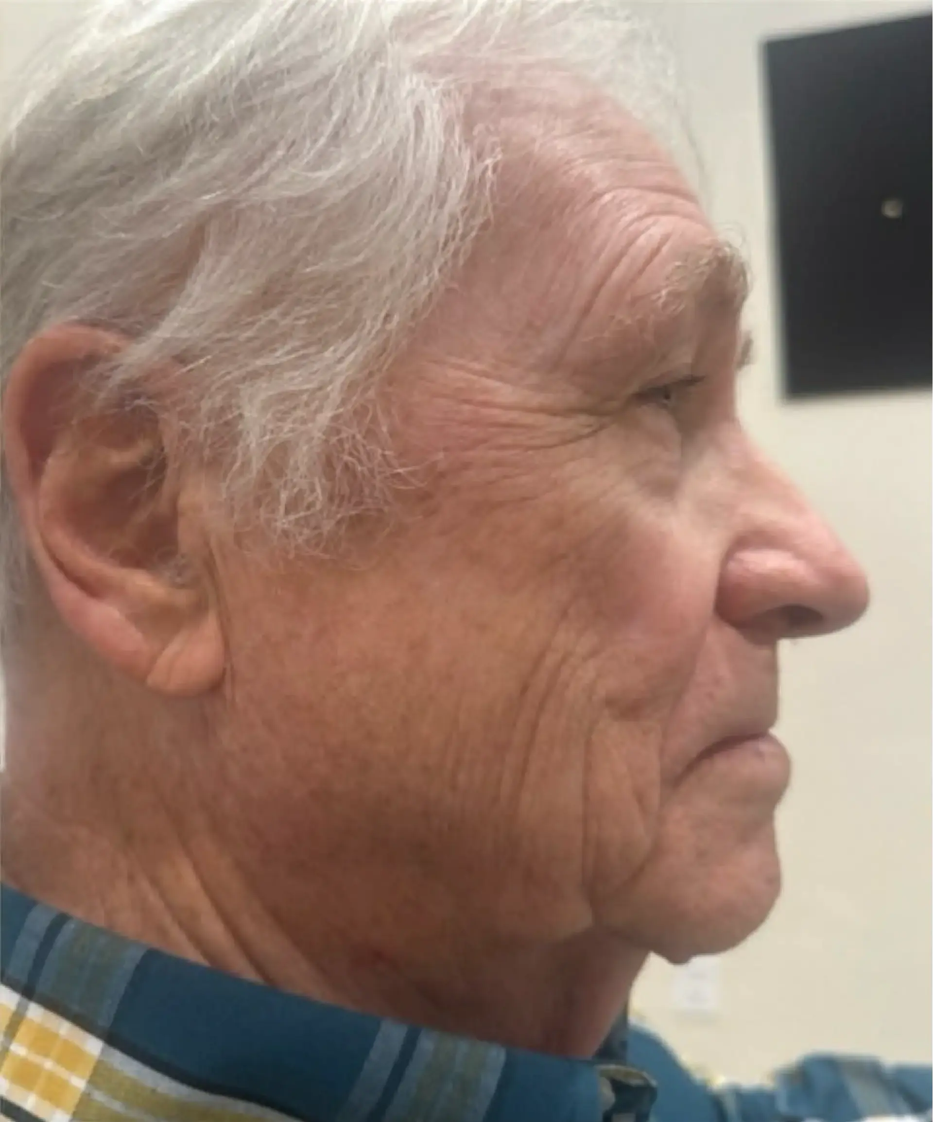 Dynasty Day & Med Spa laser treatment after — Albuquerque, NM