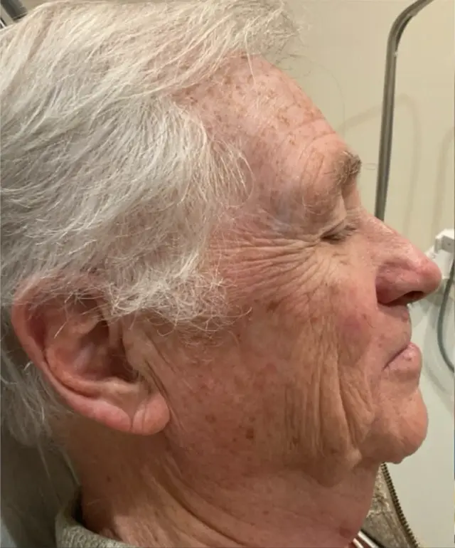 Laser Skin Resurfacing before at Dynasty Day & Med Spa in Albuquerque, NM