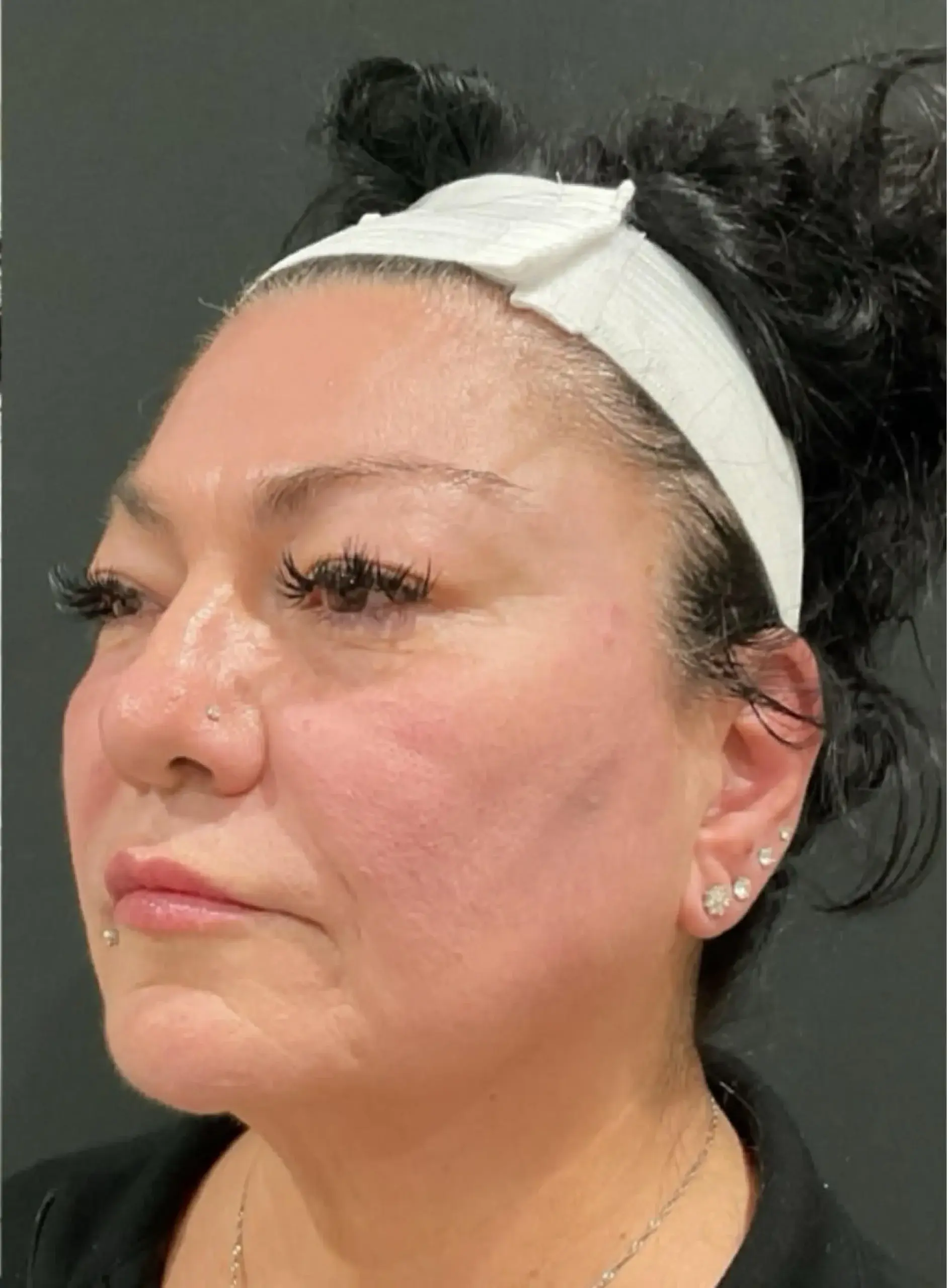 Dynasty Day & Med Spa lip filler after — Albuquerque, NM