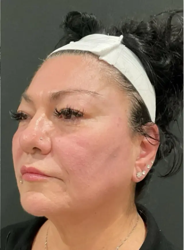 Lip Filler after at Dynasty Day & Med Spa in Albuquerque, NM