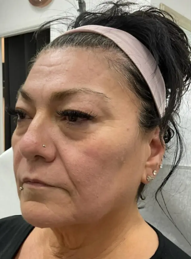 Lip Filler before at Dynasty Day & Med Spa in Albuquerque, NM