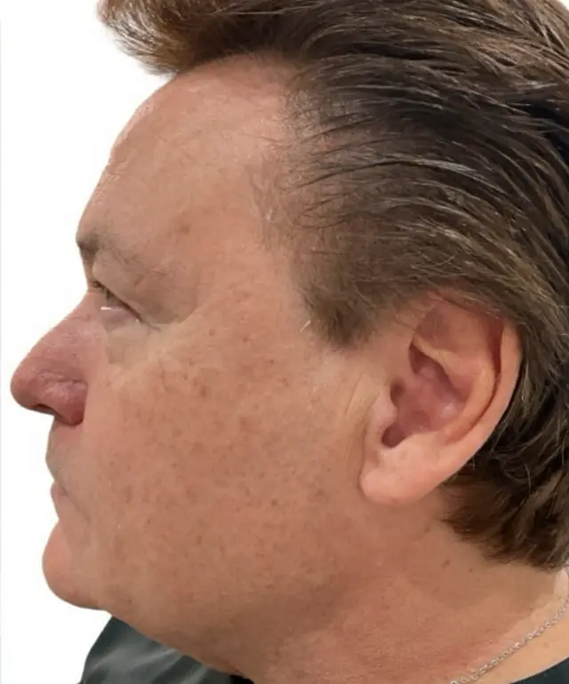 Laser Skin Resurfacing after at Dynasty Day & Med Spa in Albuquerque, NM