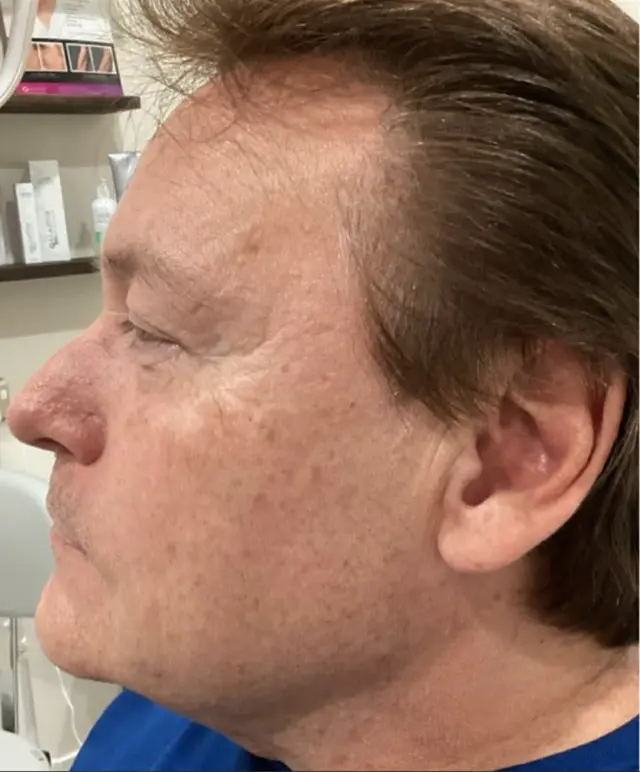 Laser Skin Resurfacing before at Dynasty Day & Med Spa in Albuquerque, NM