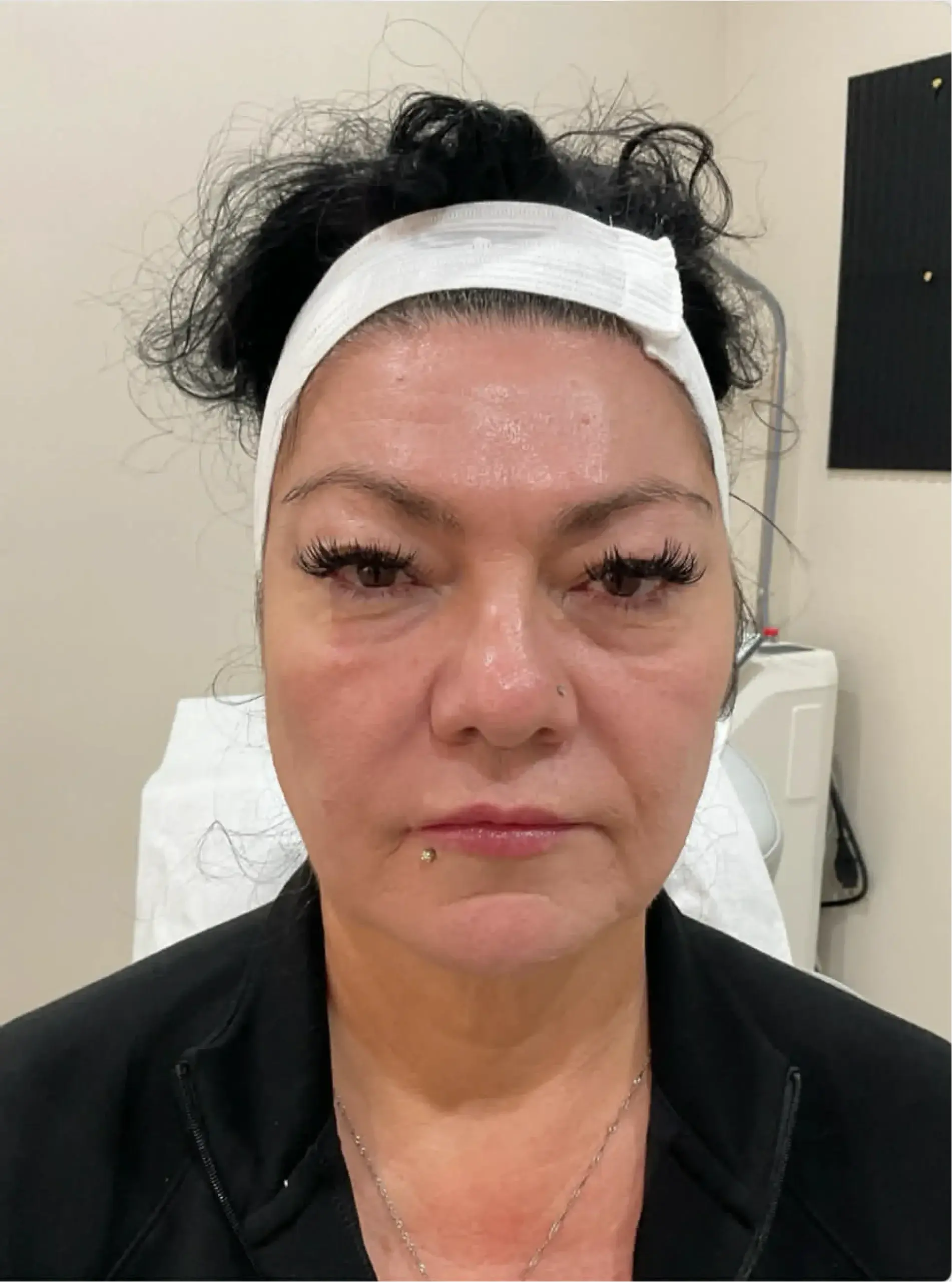 Dynasty Day & Med Spa cheek filler after — Albuquerque, NM