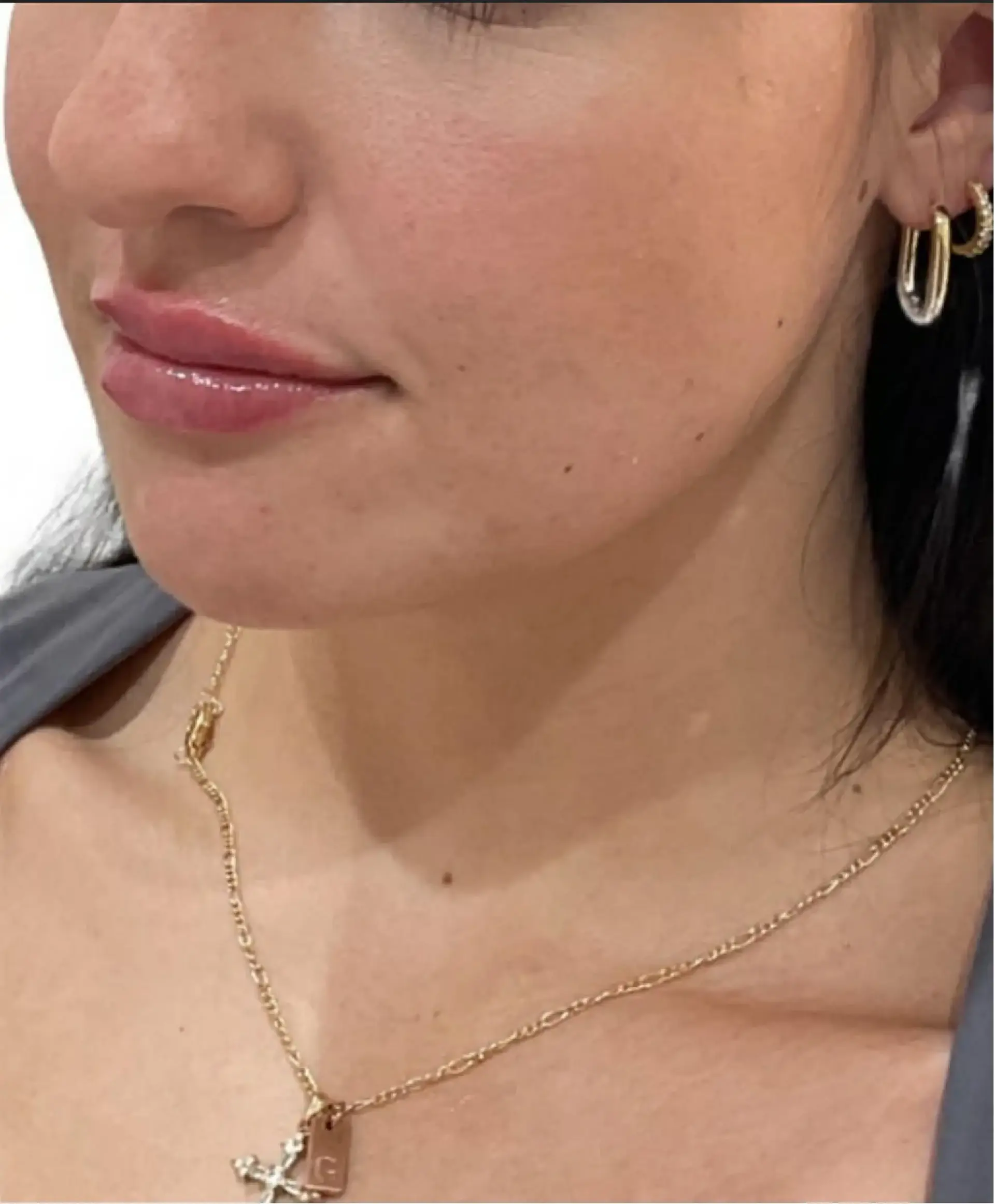 Dynasty Day & Med Spa lip filler after — Albuquerque, NM