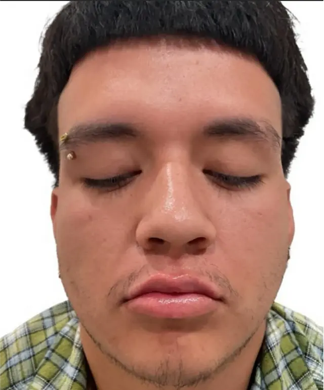 Lip Filler after at Dynasty Day & Med Spa in Albuquerque, NM