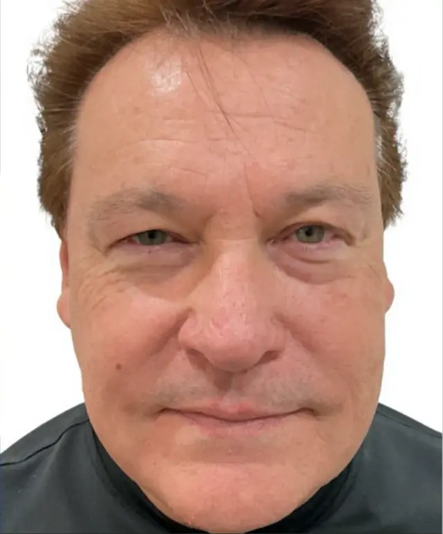 Laser Skin Resurfacing after at Dynasty Day & Med Spa in Albuquerque, NM
