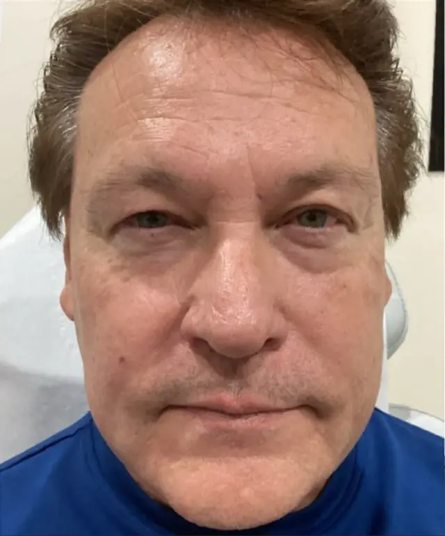 Laser Skin Resurfacing before at Dynasty Day & Med Spa in Albuquerque, NM