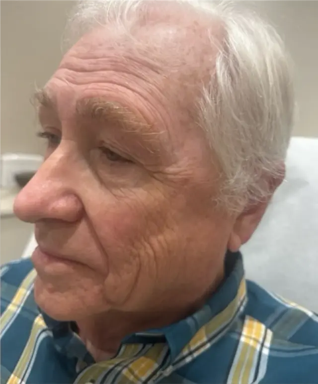 Laser Skin Resurfacing after at Dynasty Day & Med Spa in Albuquerque, NM