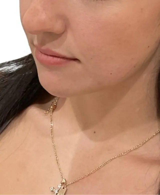 Lip Filler before at Dynasty Day & Med Spa in Albuquerque, NM