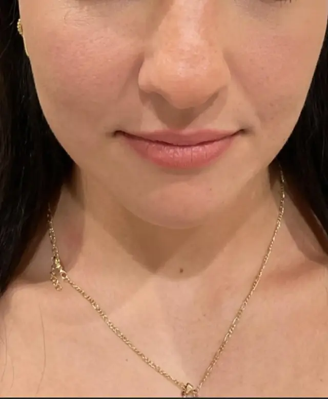 Lip Filler before at Dynasty Day & Med Spa in Albuquerque, NM