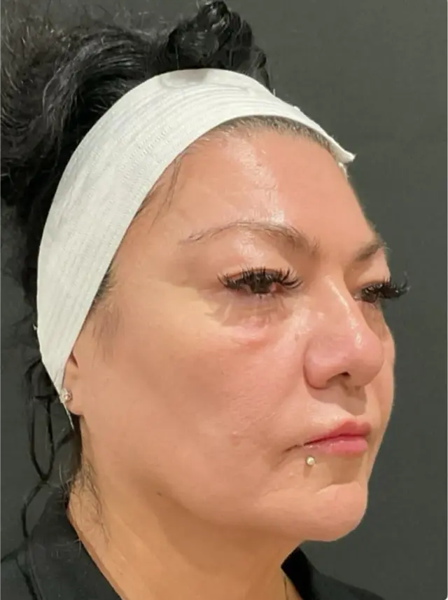 Lip Filler after at Dynasty Day & Med Spa in Albuquerque, NM