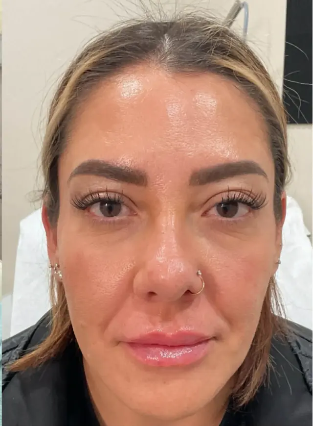 Lip Filler after at Dynasty Day & Med Spa in Albuquerque, NM