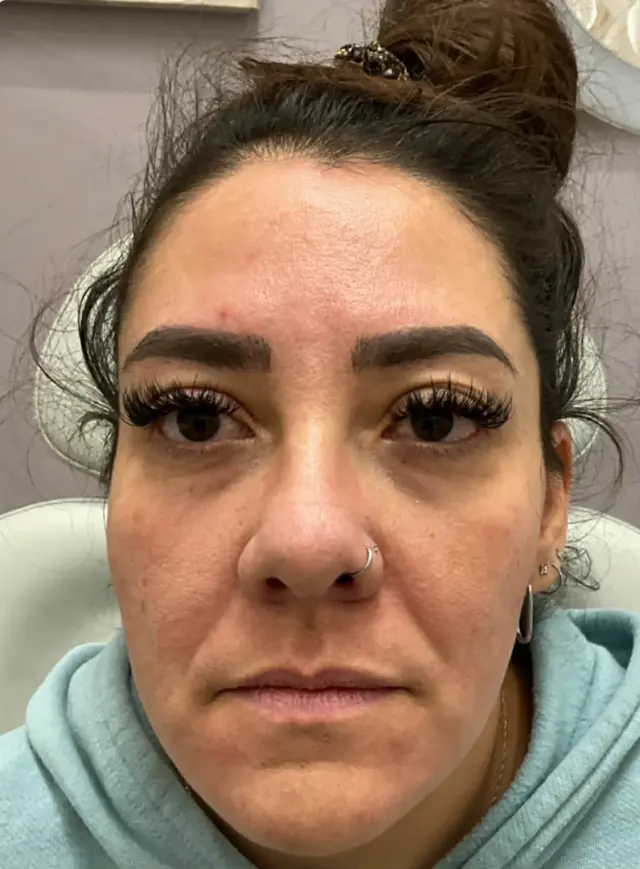 Lip Filler before at Dynasty Day & Med Spa in Albuquerque, NM