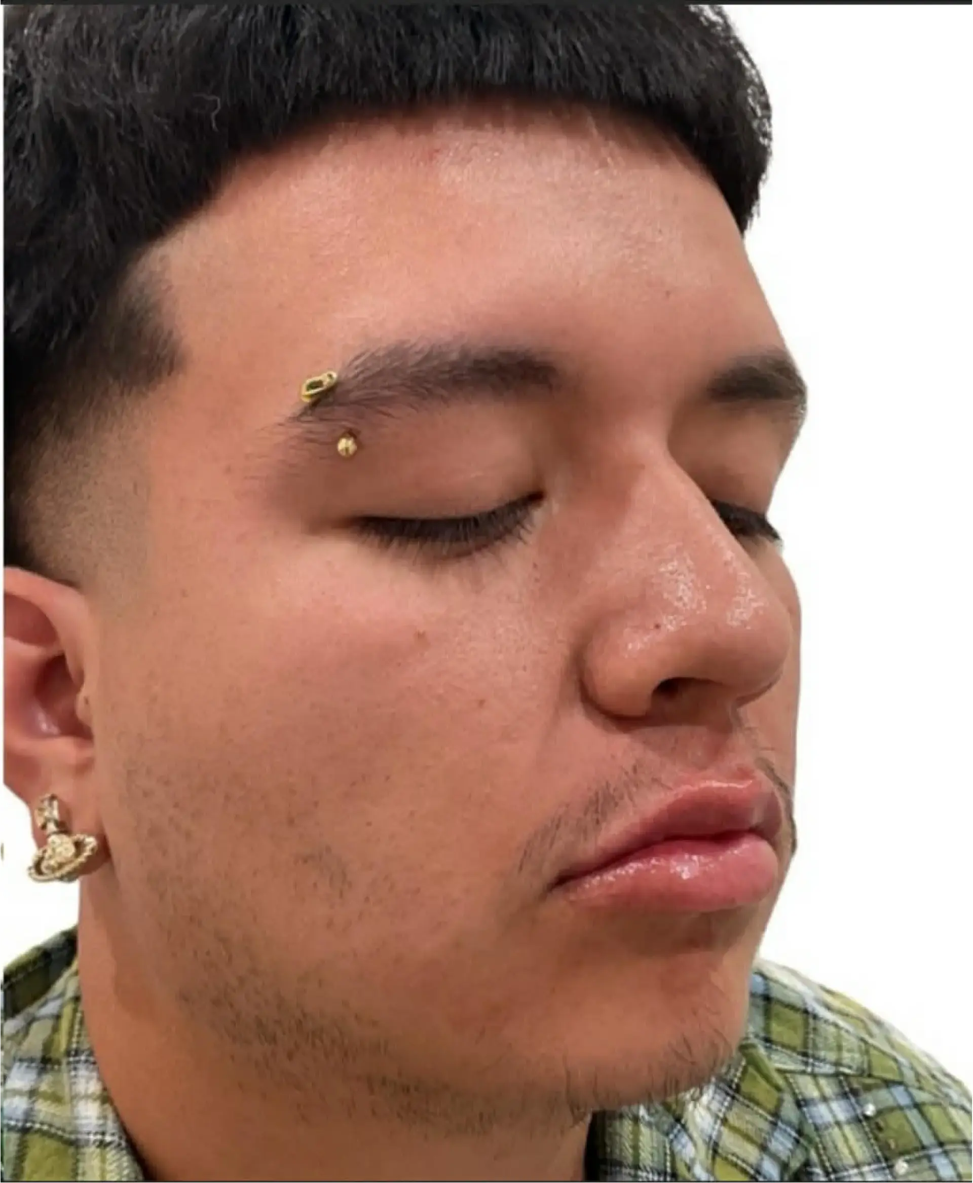 Dynasty Day & Med Spa lip filler after — Albuquerque, NM
