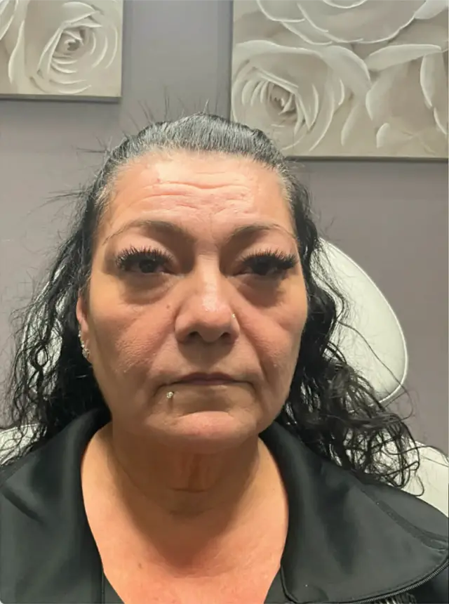 Lip Filler before at Dynasty Day & Med Spa in Albuquerque, NM