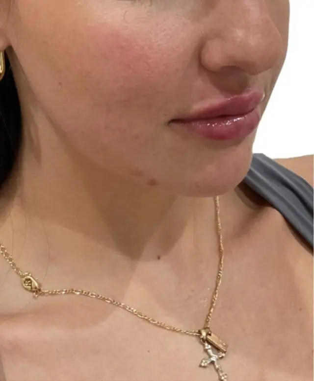 Lip Filler after at Dynasty Day & Med Spa in Albuquerque, NM