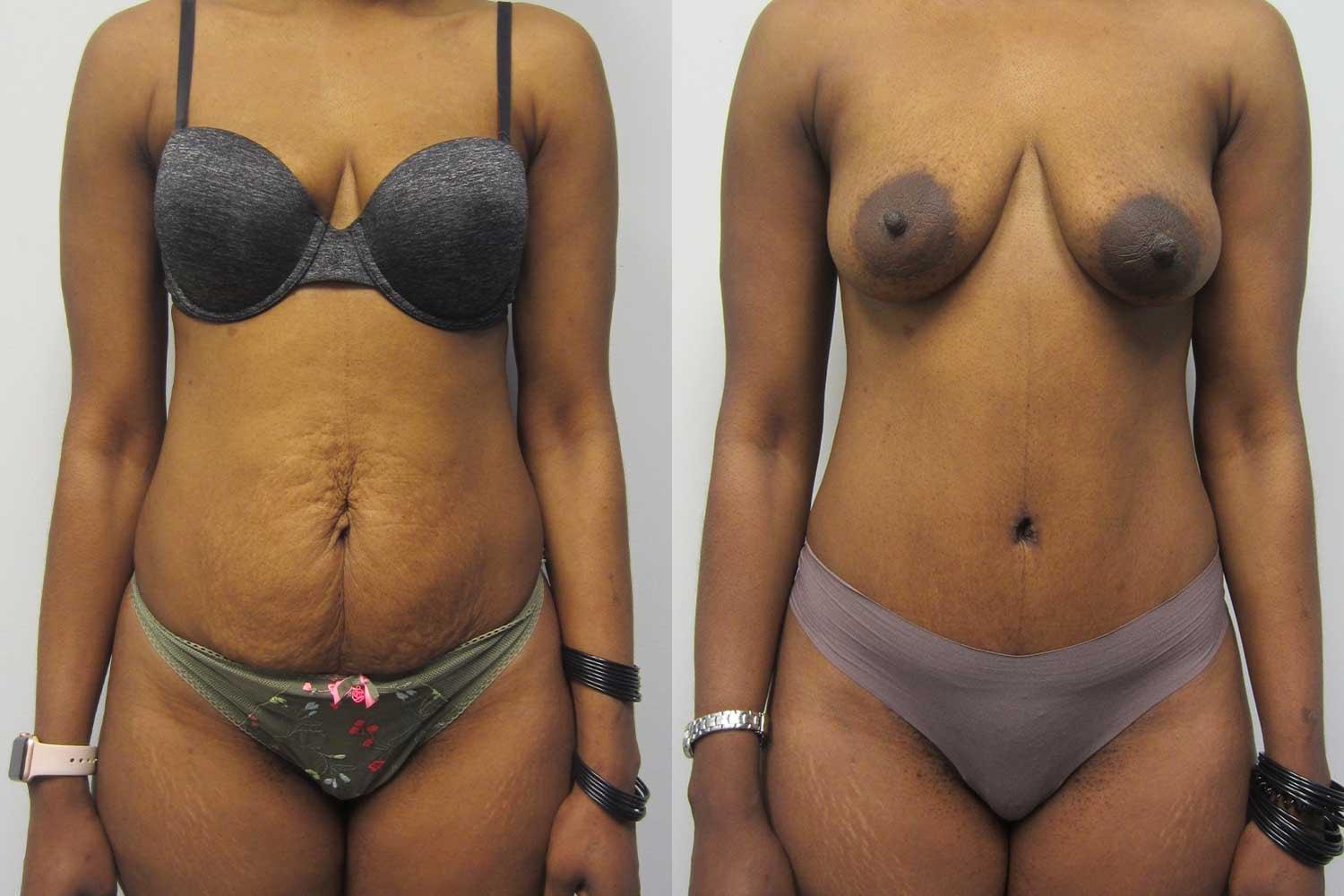 Kamran Abolmaali, MD tummy tuck result — Suwanee, GA
