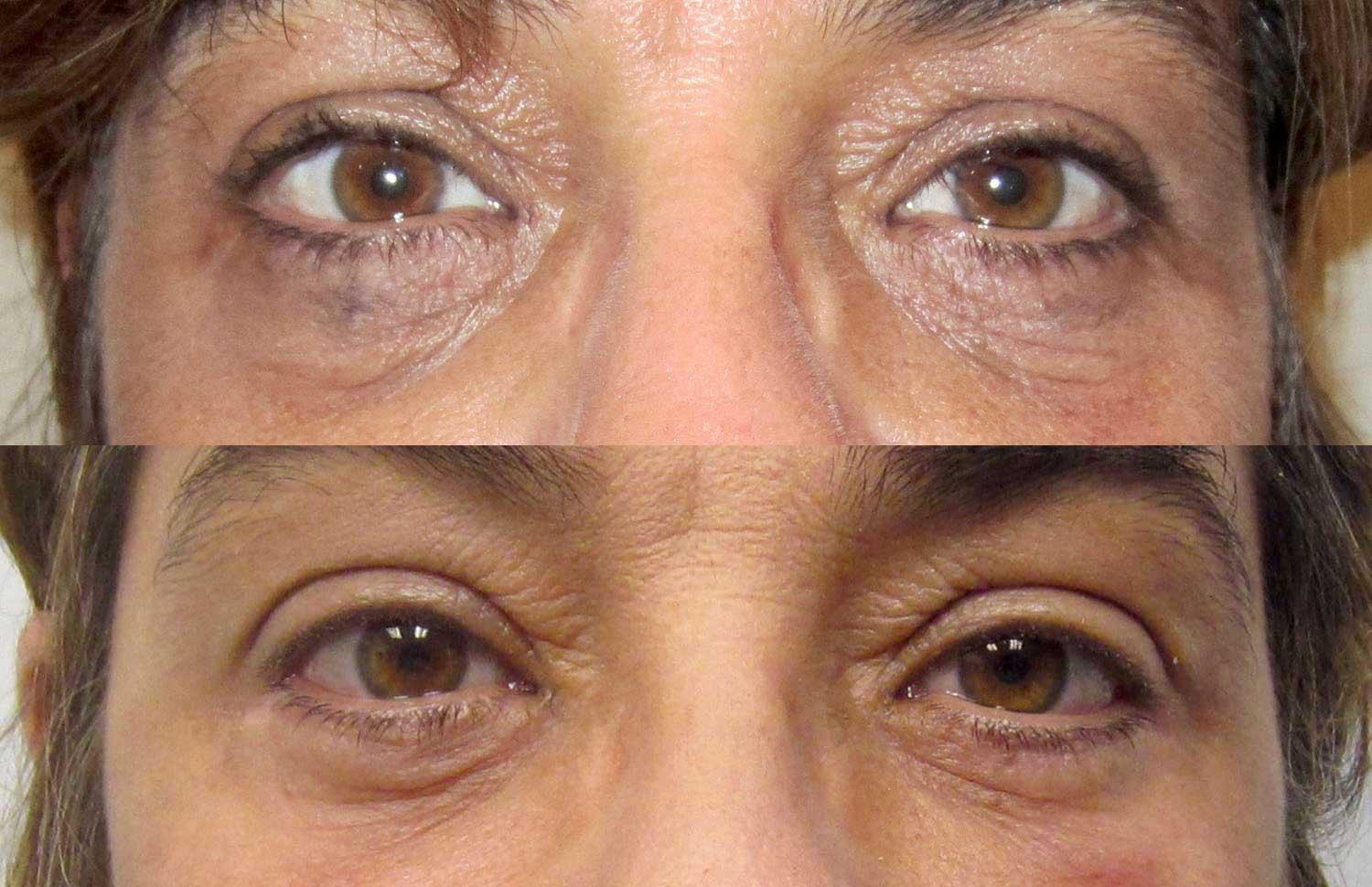 Kamran Abolmaali, MD eyelid lift result — Suwanee, GA