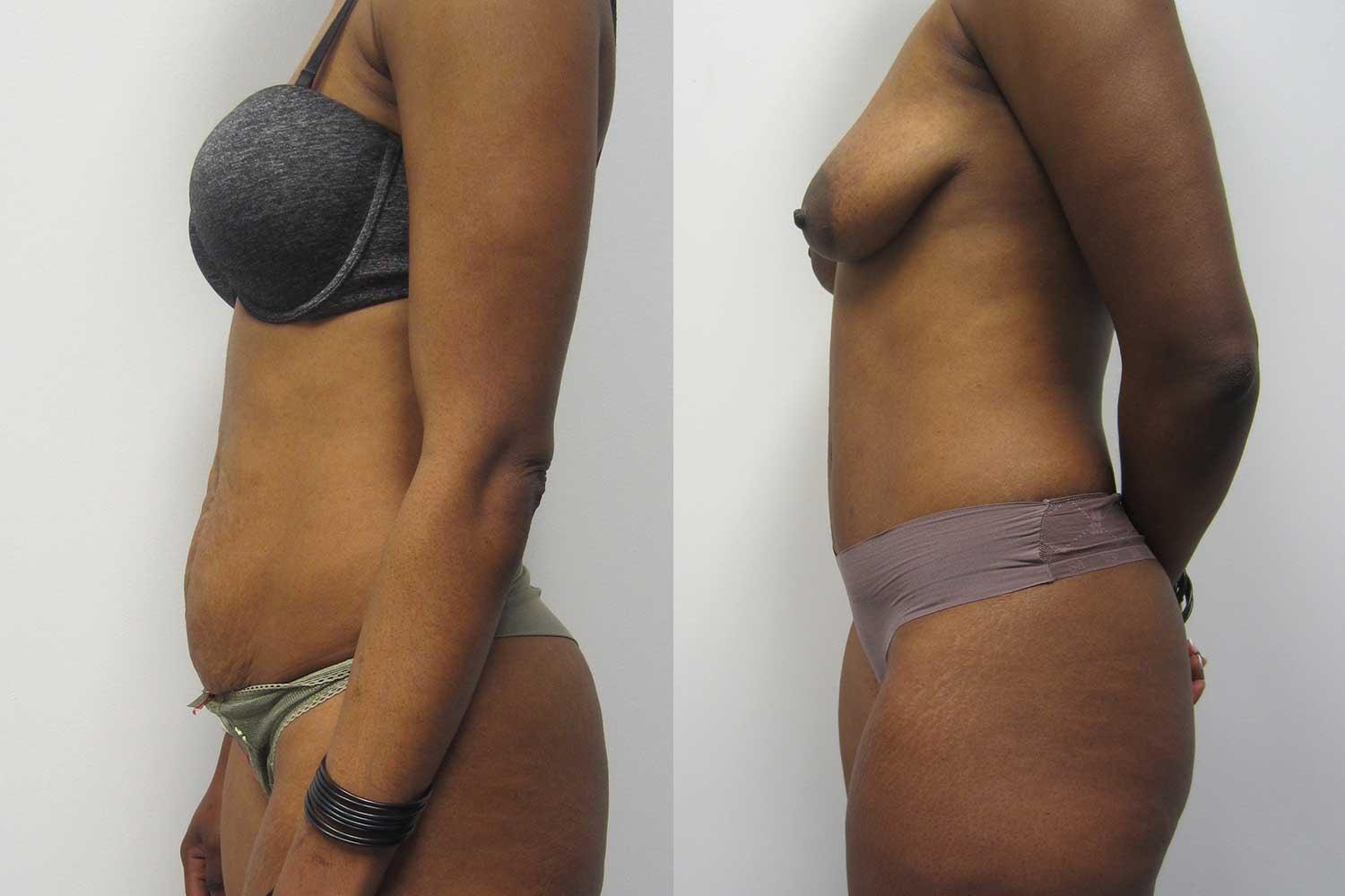 Kamran Abolmaali, MD tummy tuck result — Suwanee, GA