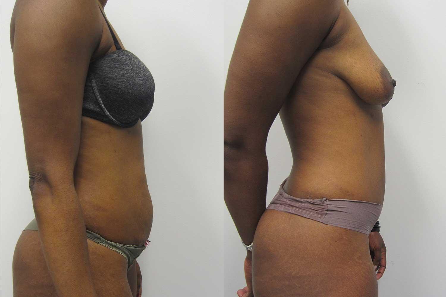 Kamran Abolmaali, MD tummy tuck result — Suwanee, GA