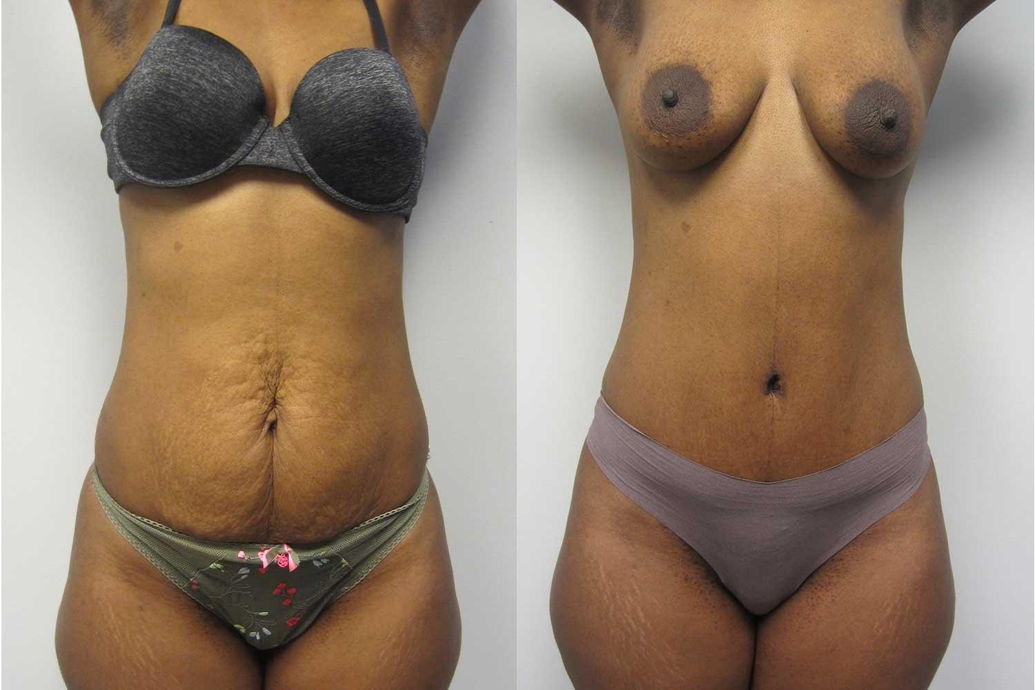 Kamran Abolmaali, MD tummy tuck result — Suwanee, GA
