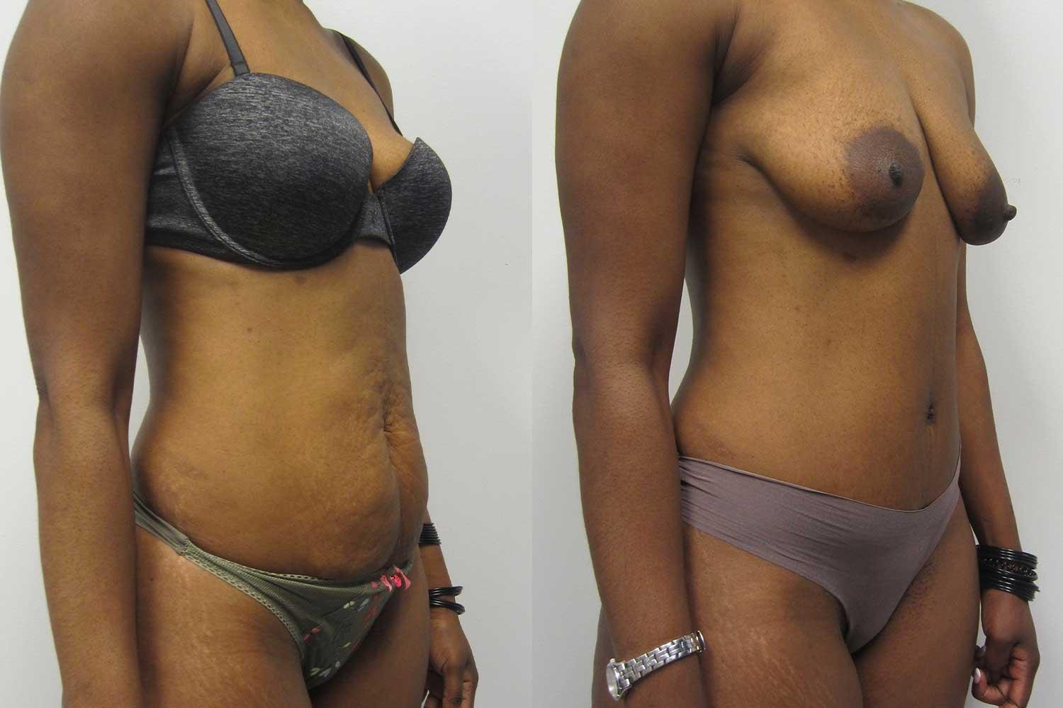 Kamran Abolmaali, MD tummy tuck result — Suwanee, GA