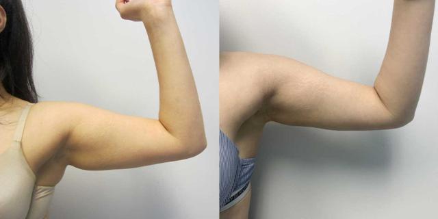 Arm Lift result at Kamran Abolmaali, MD in Suwanee, GA