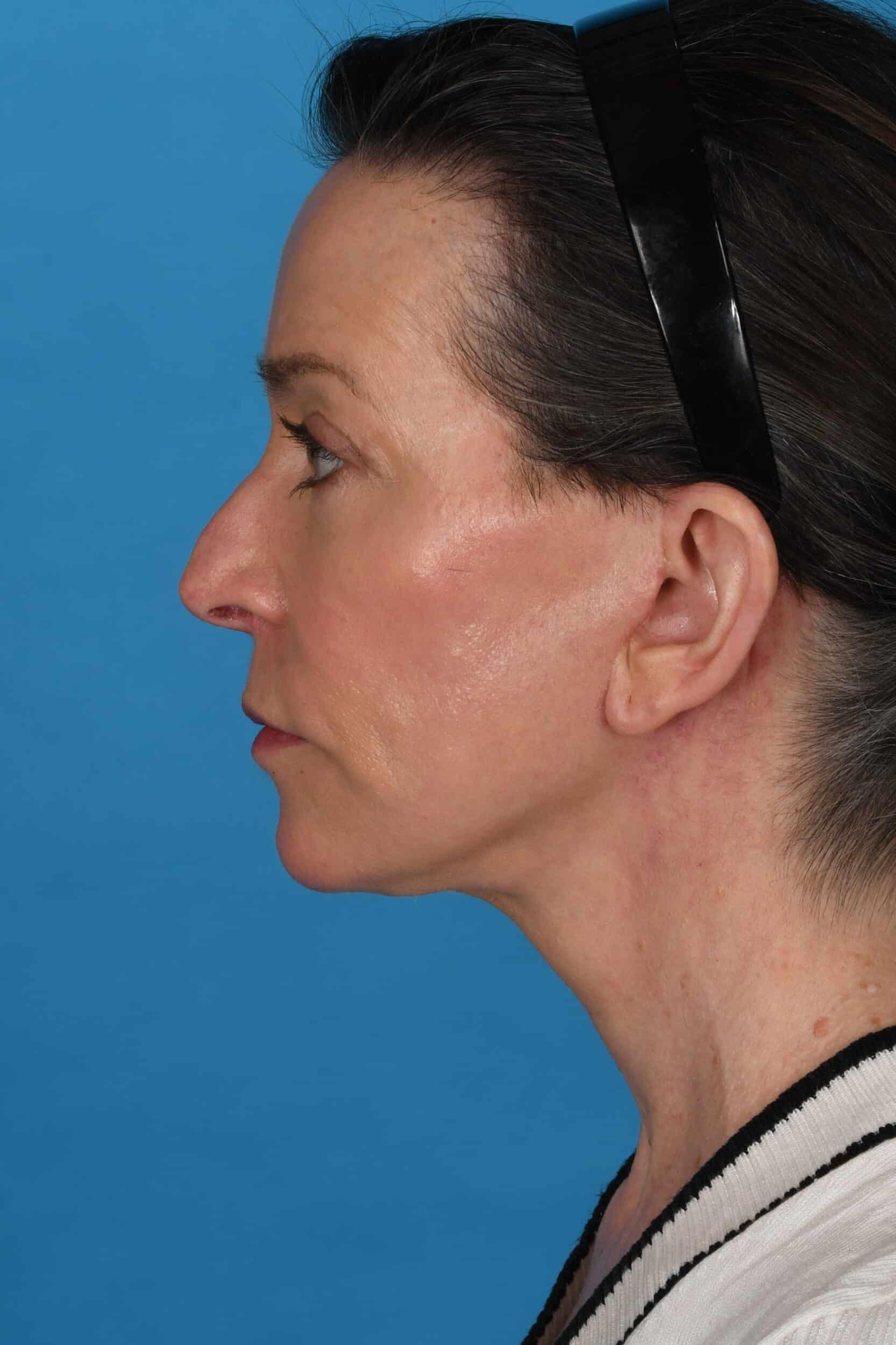 Tara Chadab, MD facelift after — New York, NY