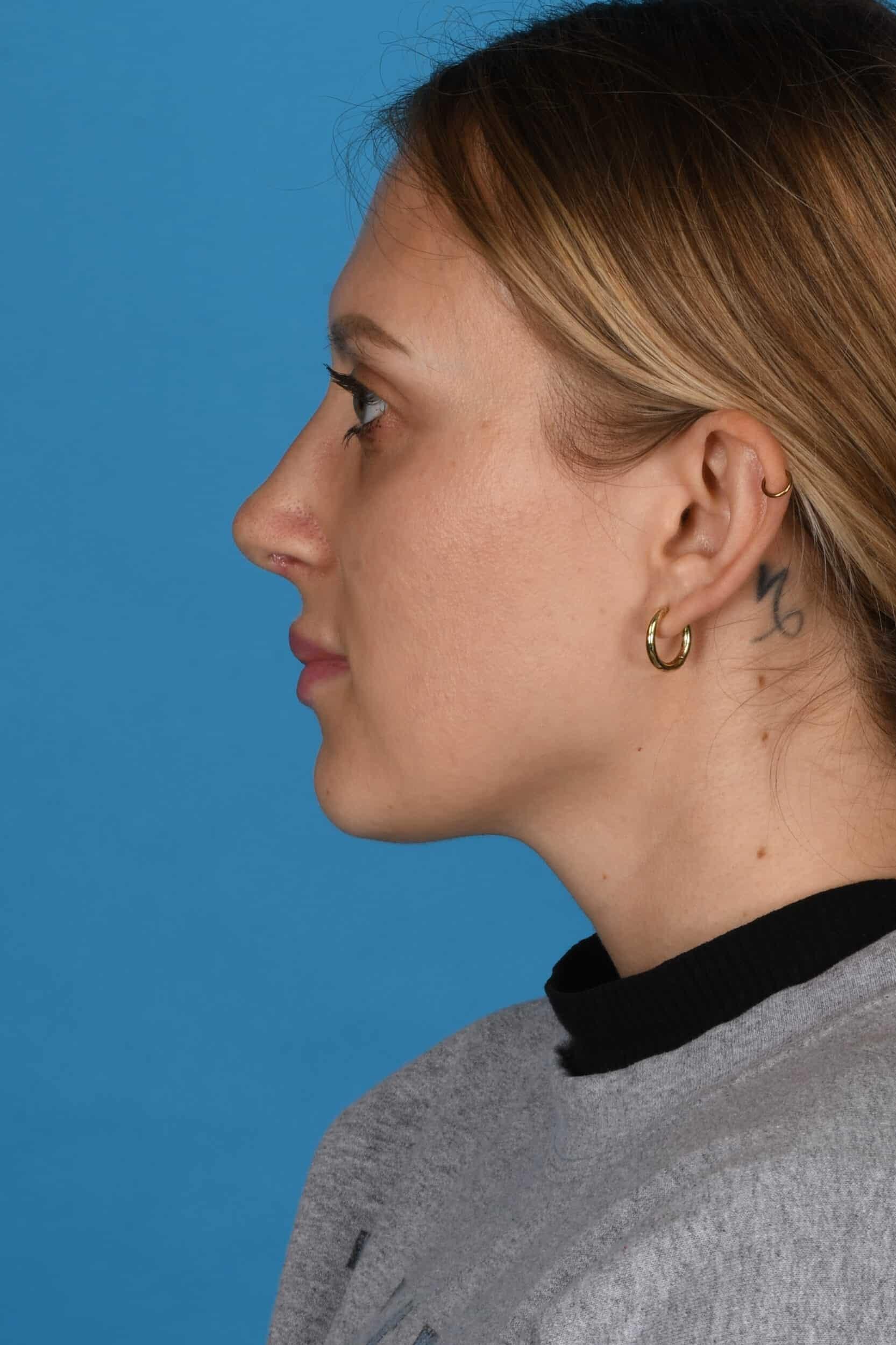 Tara Chadab, MD rhinoplasty after — New York, NY