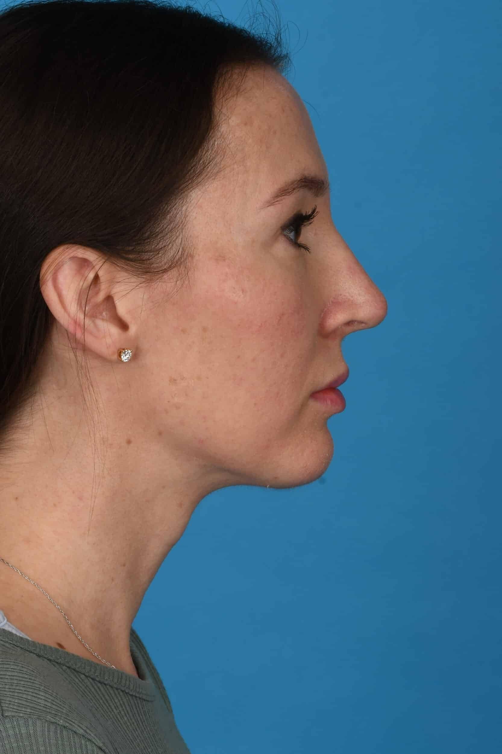 Tara Chadab, MD rhinoplasty after — New York, NY
